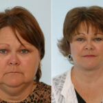 Facelift before and after photos in Houston, TX, Patient 28384