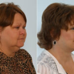 Facelift before and after photos in Houston, TX, Patient 28384