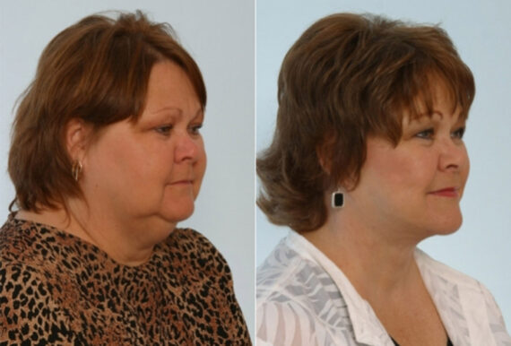 Facelift before and after photos in Houston, TX, Patient 28384