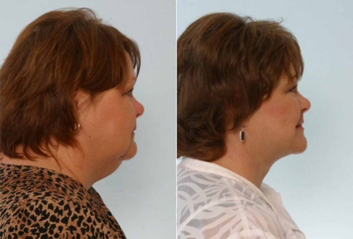 Facelift before and after photos in Houston, TX, Patient 28384