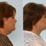 Facelift before and after photos in Houston, TX, Patient 28384