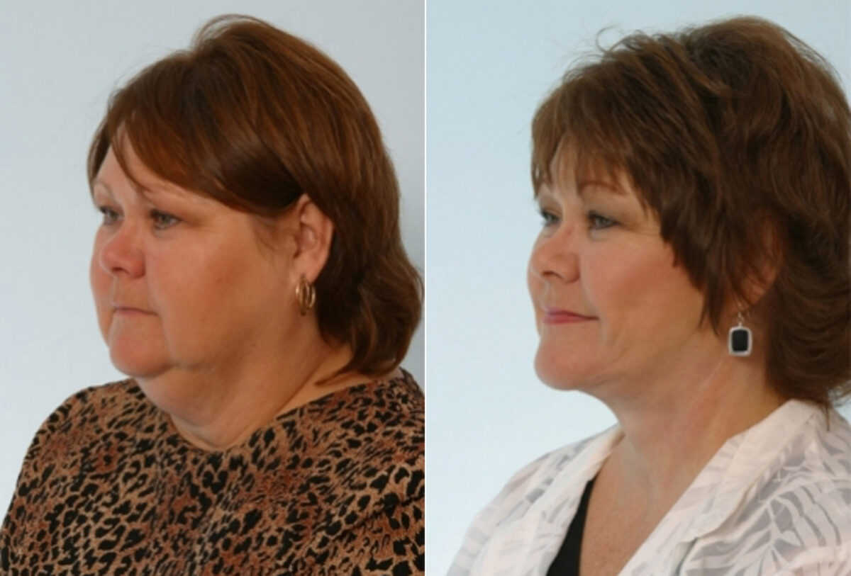 Facelift before and after photos in Houston, TX, Patient 28384