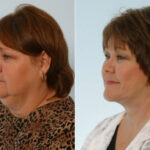 Facelift before and after photos in Houston, TX, Patient 28384