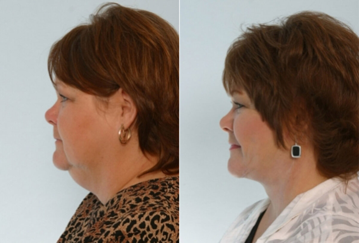 Facelift before and after photos in Houston, TX, Patient 28384