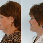 Facelift before and after photos in Houston, TX, Patient 28384