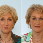 Facelift before and after photos in Houston, TX, Patient 28395