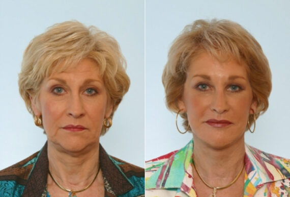 Facelift before and after photos in Houston, TX, Patient 28395
