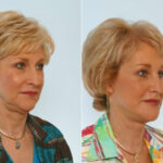 Facelift before and after photos in Houston, TX, Patient 28395