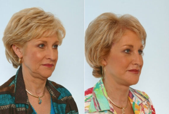 Facelift before and after photos in Houston, TX, Patient 28395