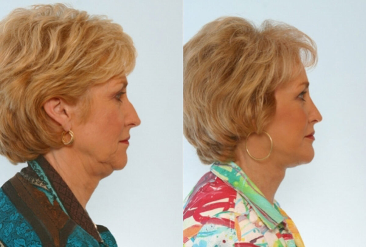 Facelift before and after photos in Houston, TX, Patient 28395