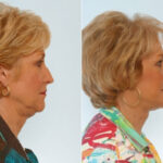 Facelift before and after photos in Houston, TX, Patient 28395