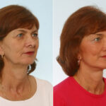 Facelift before and after photos in Houston, TX, Patient 28402