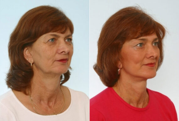 Facelift before and after photos in Houston, TX, Patient 28402