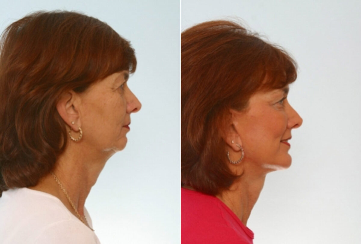 Facelift before and after photos in Houston, TX, Patient 28402