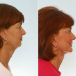 Facelift before and after photos in Houston, TX, Patient 28402