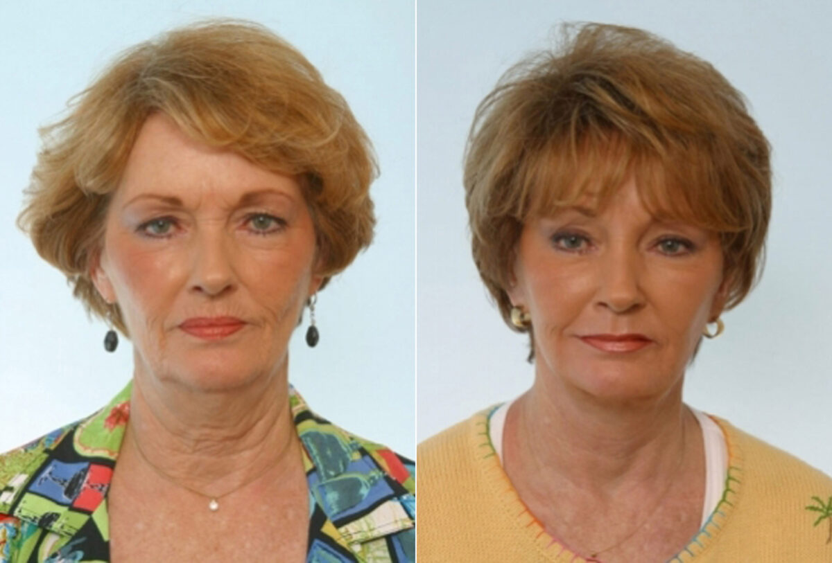 Facelift before and after photos in Houston, TX, Patient 28409