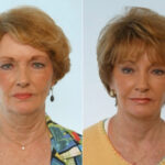 Facelift before and after photos in Houston, TX, Patient 28409