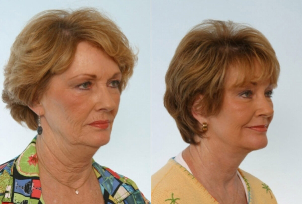 Facelift before and after photos in Houston, TX, Patient 28409
