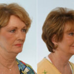 Facelift before and after photos in Houston, TX, Patient 28409