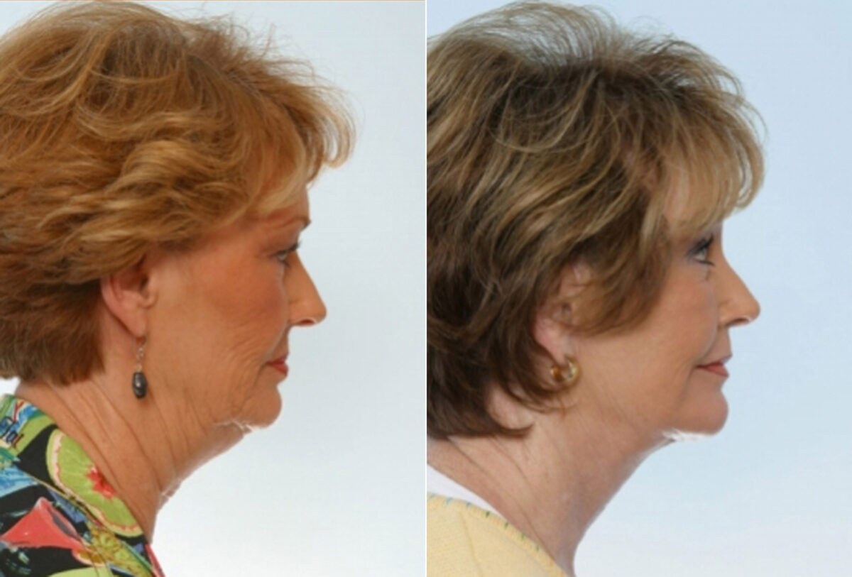 Facelift before and after photos in Houston, TX, Patient 28409