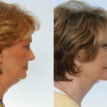 Facelift before and after photos in Houston, TX, Patient 28409