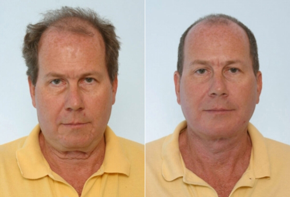 Facelift before and after photos in Houston, TX, Patient 28416