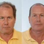 Facelift before and after photos in Houston, TX, Patient 28416