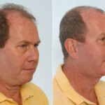 Facelift before and after photos in Houston, TX, Patient 28416