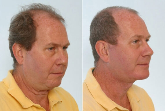 Facelift before and after photos in Houston, TX, Patient 28416