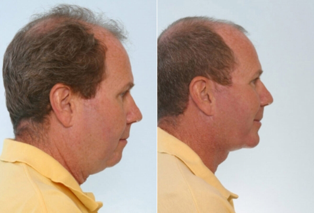 Facelift before and after photos in Houston, TX, Patient 28416