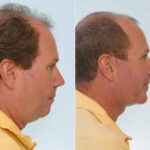 Facelift before and after photos in Houston, TX, Patient 28416