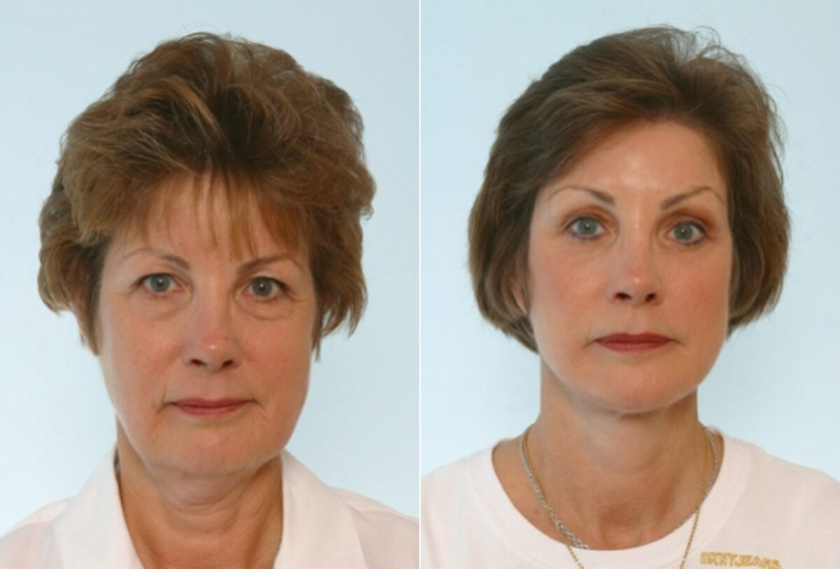 Facelift before and after photos in Houston, TX, Patient 28423