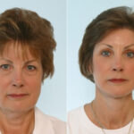 Facelift before and after photos in Houston, TX, Patient 28423