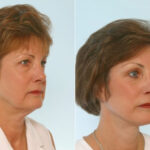Facelift before and after photos in Houston, TX, Patient 28423