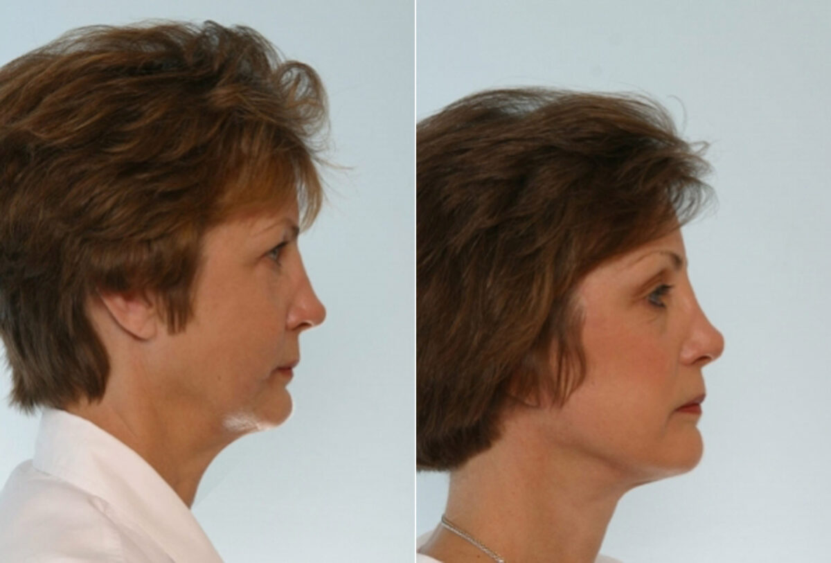 Facelift before and after photos in Houston, TX, Patient 28423