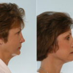 Facelift before and after photos in Houston, TX, Patient 28423