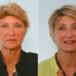 Facelift before and after photos in Houston, TX, Patient 28430