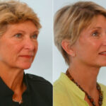 Facelift before and after photos in Houston, TX, Patient 28430