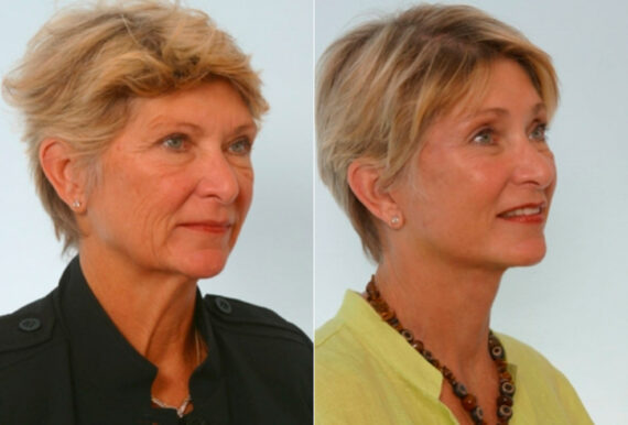 Facelift before and after photos in Houston, TX, Patient 28430