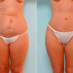 Abdominoplasty before and after photos in Houston, TX, Patient 24624