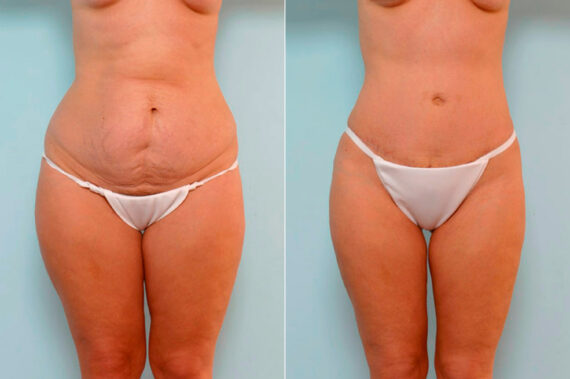 Tummy Tuck/Abdominoplasty before and after photos in Houston, TX