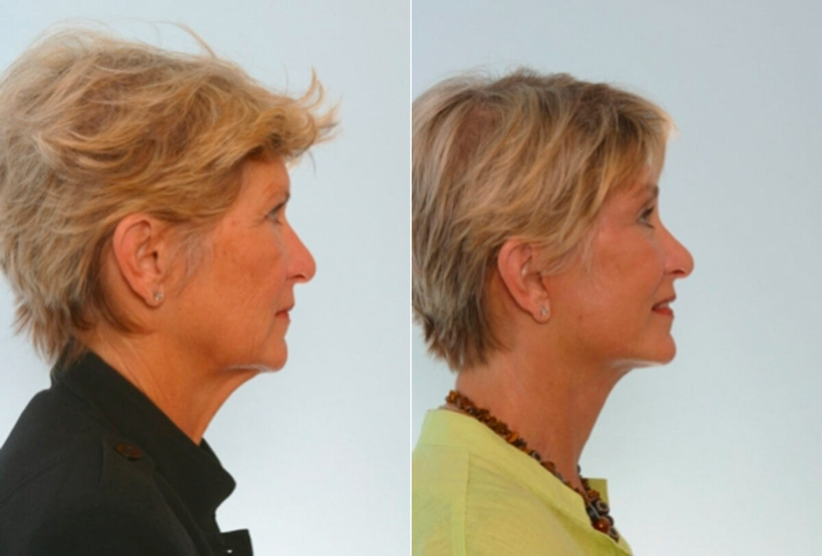 Facelift before and after photos in Houston, TX, Patient 28430