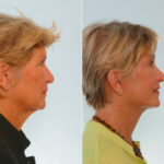 Facelift before and after photos in Houston, TX, Patient 28430