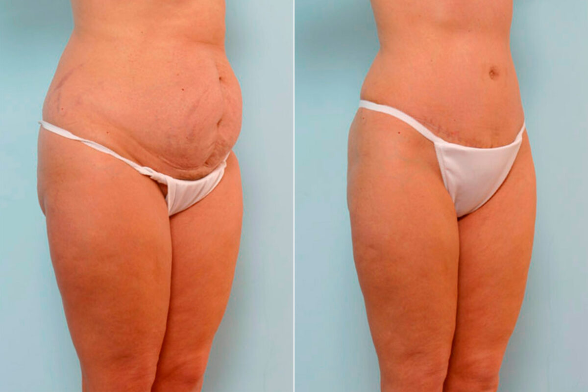 Tummy Tuck/Abdominoplasty before and after photos in Houston, TX, Patient 24624