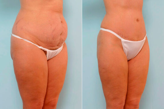 Abdominoplasty before and after photos in Houston, TX, Patient 24624