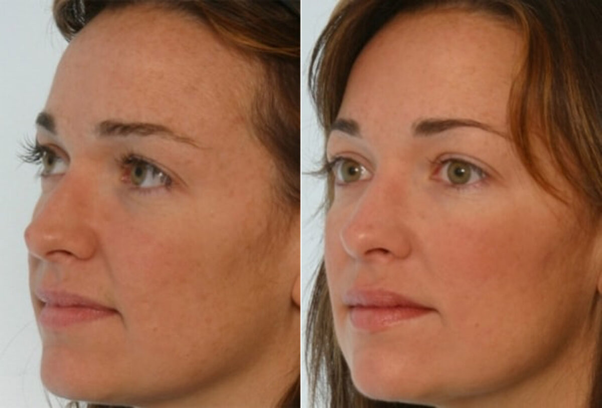 Fillers before and after photos in Houston, TX, Patient 28474