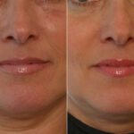 Fillers before and after photos in Houston, TX, Patient 28483