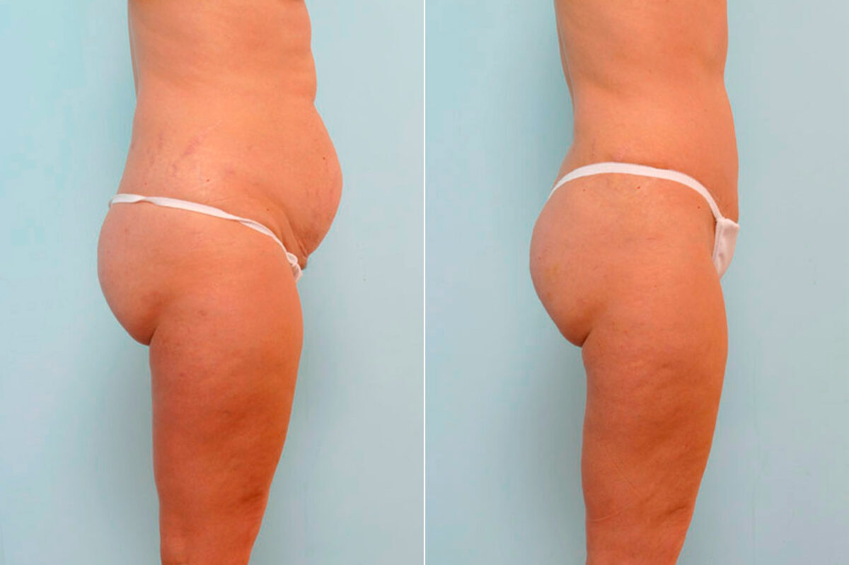 Abdominoplasty before and after photos in Houston, TX, Patient 24624