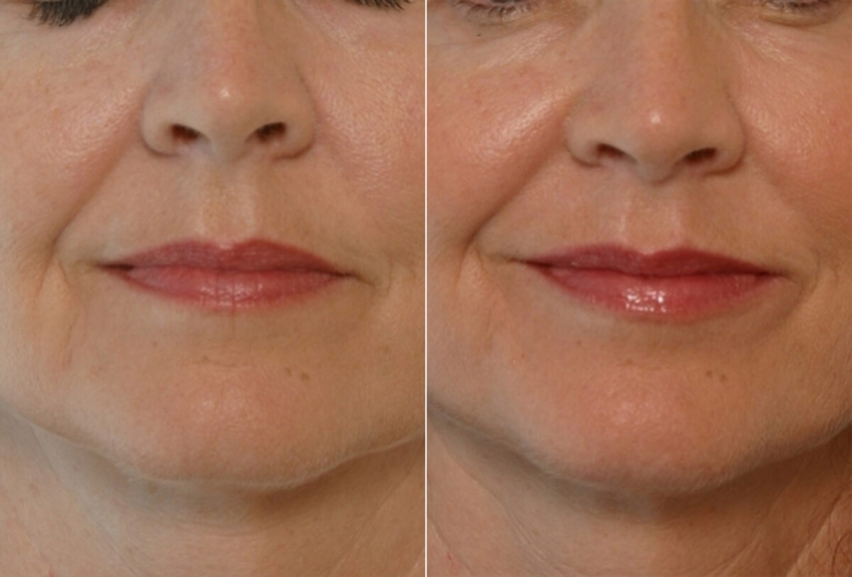 Fillers before and after photos in Houston, TX, Patient 28486