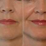 Fillers before and after photos in Houston, TX, Patient 28486